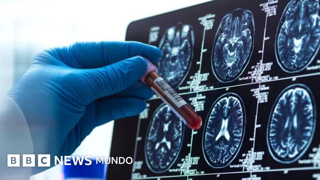 Cuatro innovaciones prometedoras en el tratamiento del Alzheimer en 2023